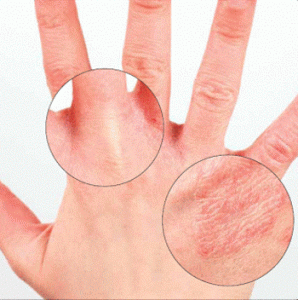 gejala klinis psoriasis vörös foltok jelennek meg és tűnnek el a bőrön