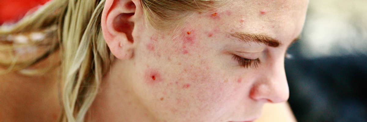 bőrparazita az arcon