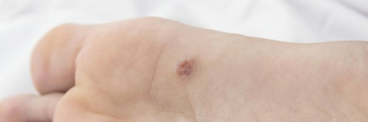 diyphlobotriasis táplálkozási higiénia hpv a bőrben