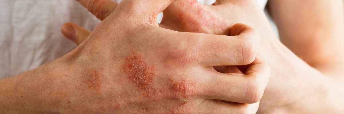bőrbetegségek vörös foltok a kezeken