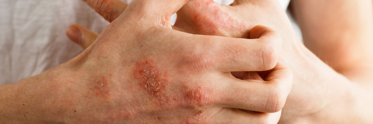 Pikkelysömör (pszoriázis, psoriasis) tünetei és kezelése