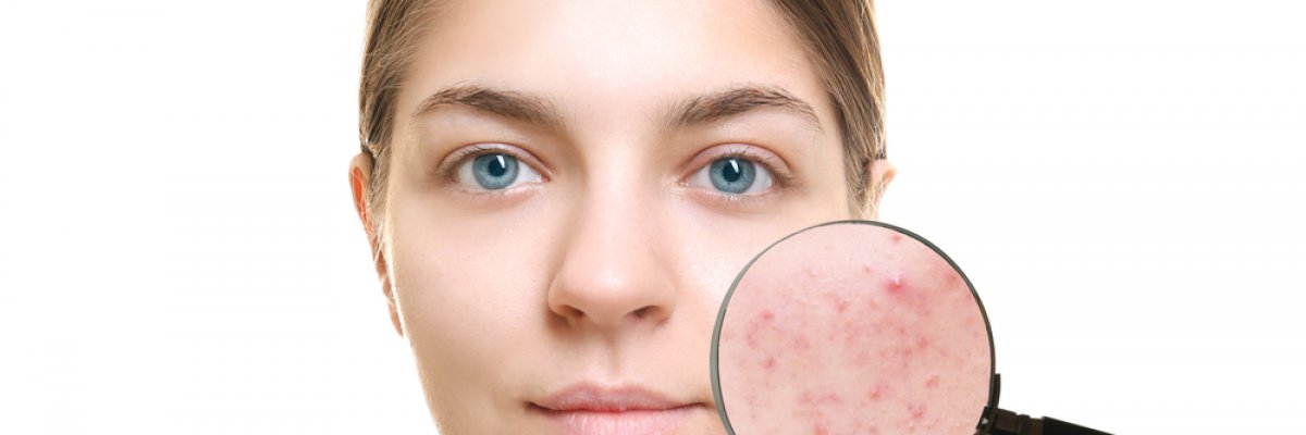 Krém az arc bőrgyulladására - a legjobb krémek és kenőcsök a kezeléshez - Allergének August