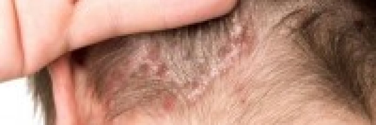 Pikkelysömör (pszoriázis, psoriasis) tünetei és kezelése