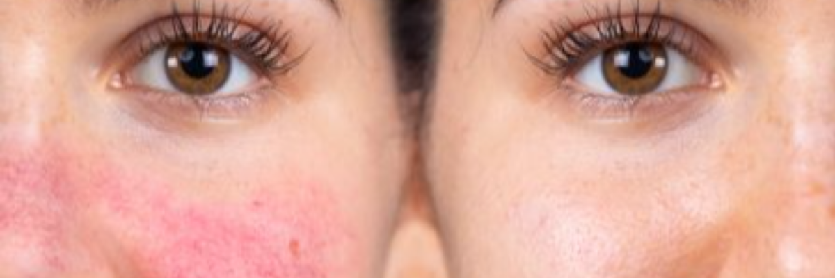 Kipirosodás az orrán, orcáján? Idejében el kell kezdeni a rozácea kezelését