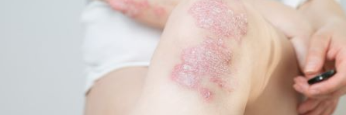 Belobbant a pikkelysömör? A tünetcsökkentés mellett a fenntartó kezelés is fontos