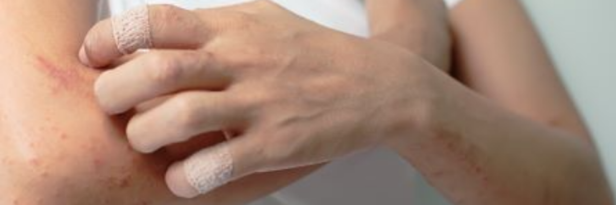 Ősszel fellángoló ekcéma - mi ronthatja a bőr állapotát?