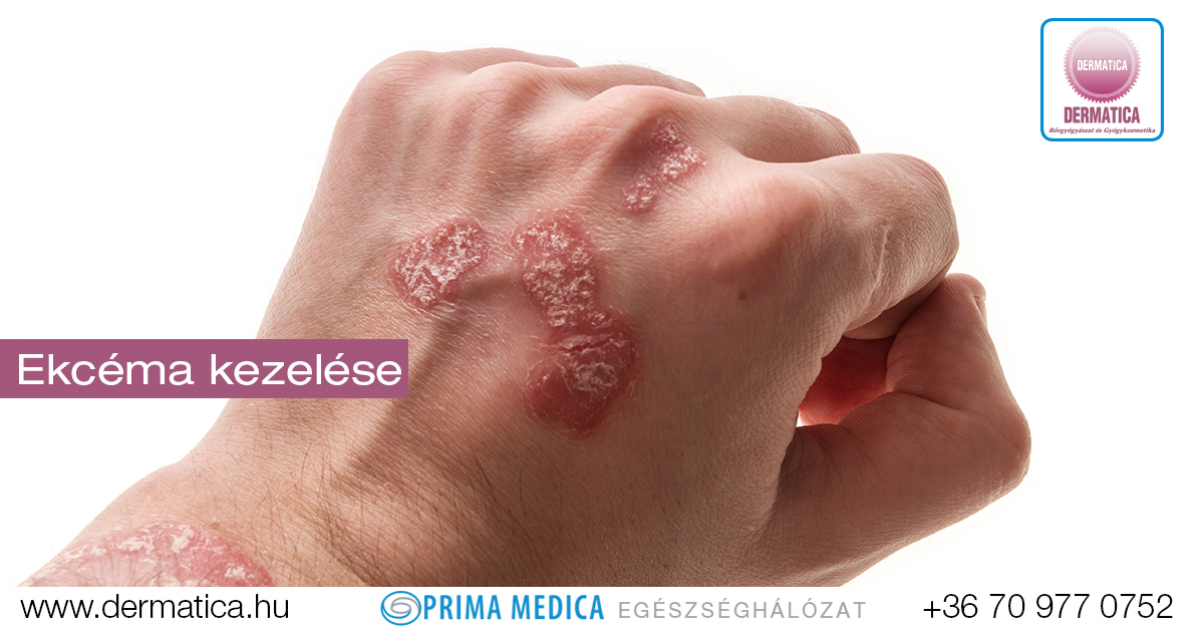 pikkelyes papilloma arc
