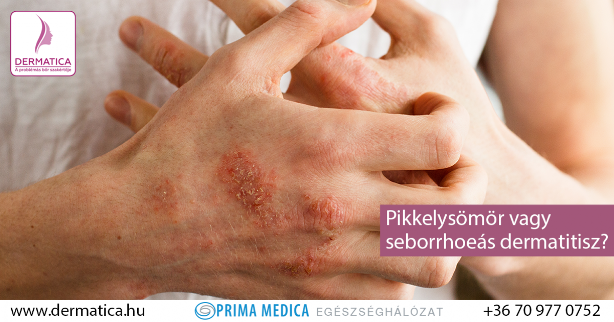 A seborrhea tünetei és kezelése