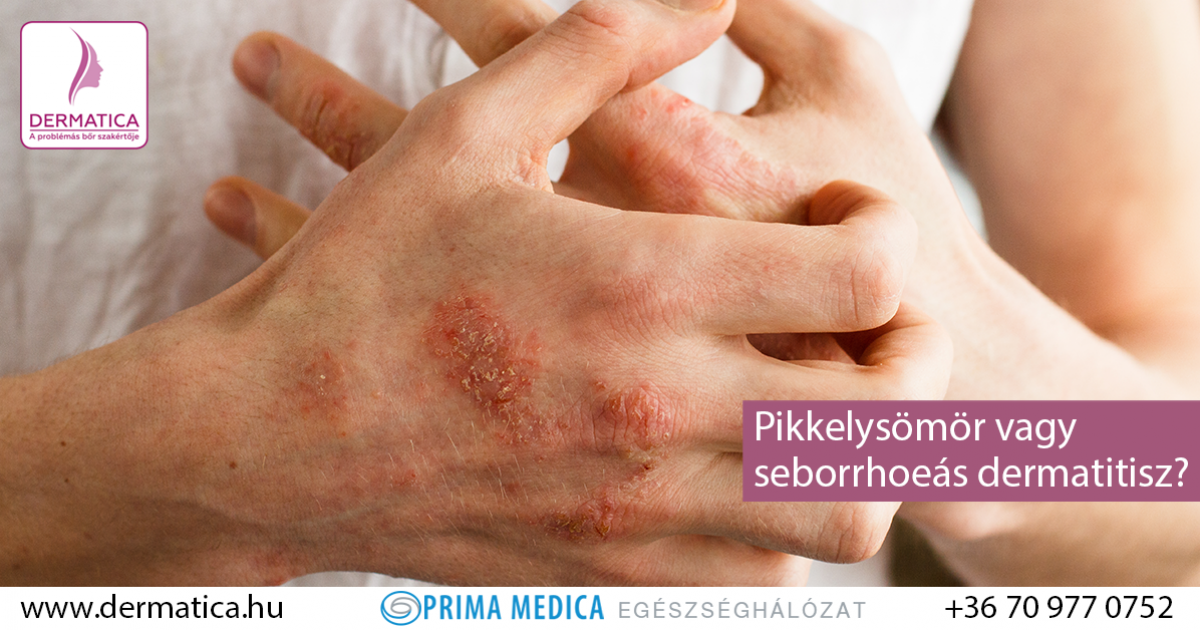 hogyan kell kezelni a dermatitist s a pikkelysmrt pikkelysömör kezelésére kenőcs vélemények fotók előtt és után