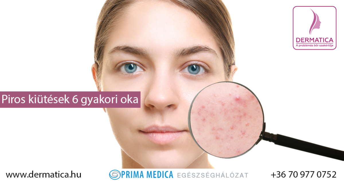 Emésztési problémákról árulkodó bőr | BENU Gyógyszertárak, Piros foltok az arcon pontok formájában