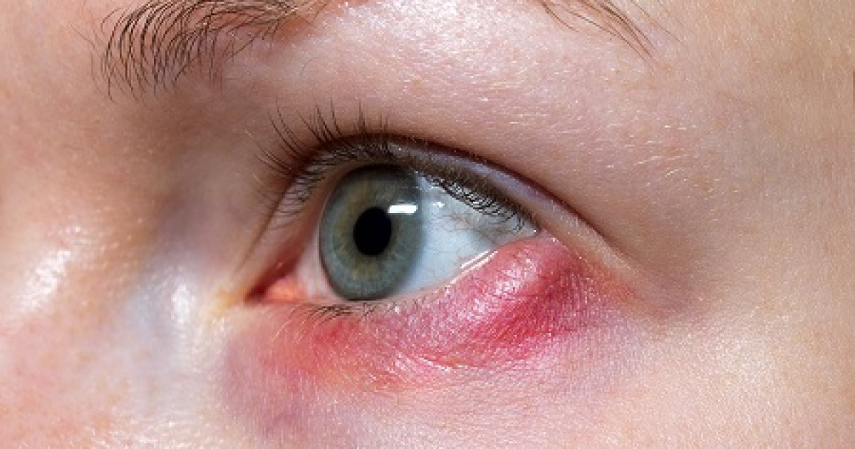 Kiszáradt, hámló bőr a szemkörnyéken: 7 betegség, aminek a tünete lehet - Szépség és divat | Femina