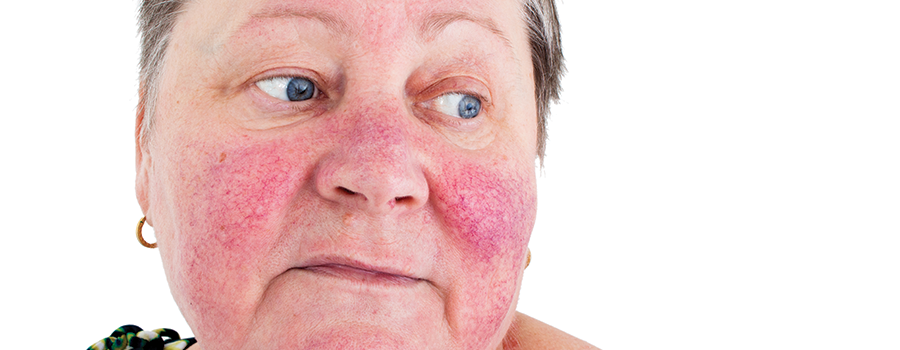 Rosacea