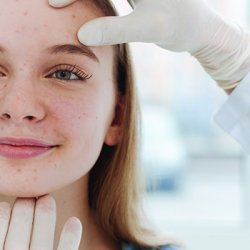 Rosacea tünetei és kezelése
