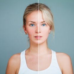 Bőrhámlasztás - otthon vagy szakembernél?