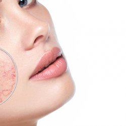 Rosacea