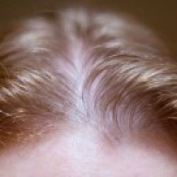 Meddig normális az őszi hajhullás? - DERMATICA