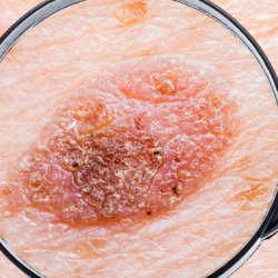 Anyajegy, melanoma