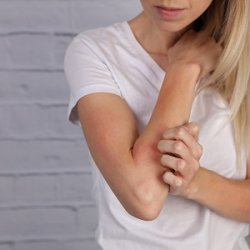 Bőrgyógyász tanácsai a pikkelysömör fellángolásának megelőzéséhez