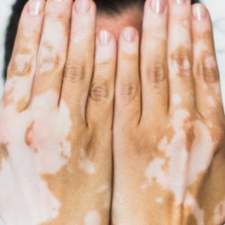 Vitiligo