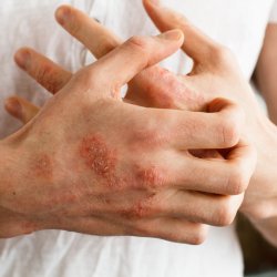Pikkelysömör vagy seborrhoeás dermatitisz? Hasonló, de nem ugyanaz