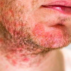 Szeborreás dermatitis