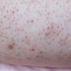 Keratosis pilaris