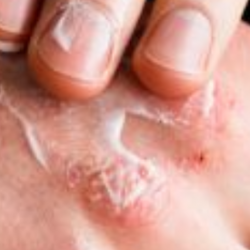 Az atópiás dermatitisztől az ekcémáig