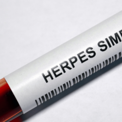 Herpes simplex