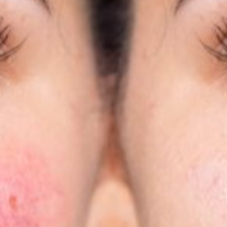 Kipirosodás az orrán, orcáján? Idejében el kell kezdeni a rozácea kezelését