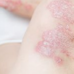 Belobbant a pikkelysömör? A tünetcsökkentés mellett a fenntartó kezelés is fontos