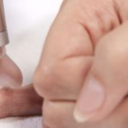 Mikor kell eltávolítani a bőrkinövést?