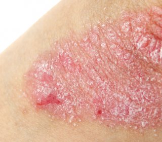 Psoriasis van a fejemben hogyan tudom kezelni)