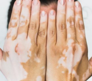 A százaz bőr - minden, amit tudni kell a száraz bőrről