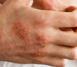 allergiás dermatitis kezelés cukorbetegséggel)
