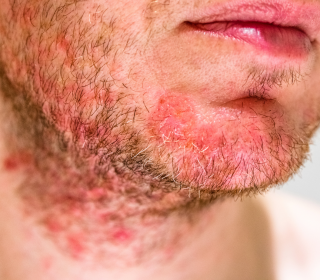 Szeborreás Dermatitis