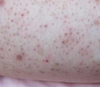 Keratosis Pilaris