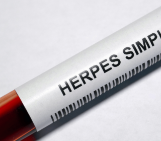 Herpes simplex