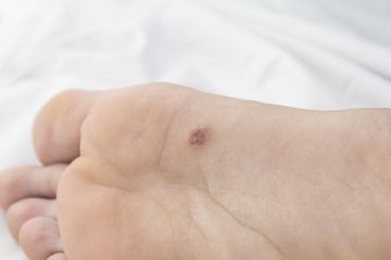 barna szemölcs mi ez genitális herpesz vagy hpv