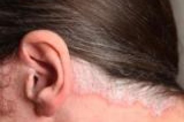 vörös pikkelyes foltok a fülek mögött a pikkelysömör 5 nap alatt gyógyítható