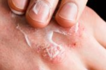 Az atópiás dermatitisztől az ekcémáig