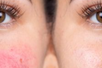 Kipirosodás az orrán, orcáján? Idejében el kell kezdeni a rozácea kezelését