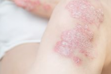 Belobbant a pikkelysömör? A tünetcsökkentés mellett a fenntartó kezelés is fontos