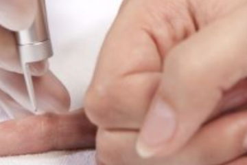 Mikor kell eltávolítani a bőrkinövést?