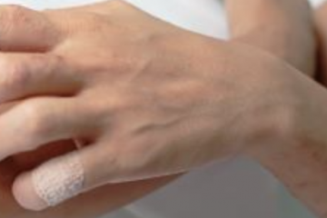 Ősszel fellángoló ekcéma - mi ronthatja a bőr állapotát?