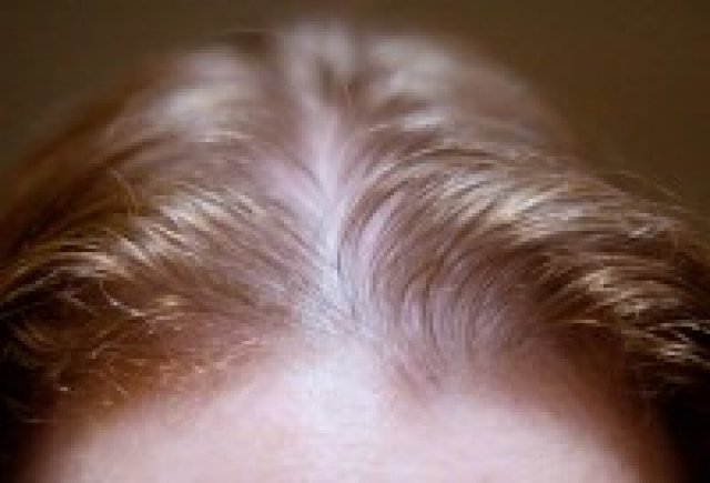 Meddig normális az őszi hajhullás? - DERMATICA Meddig normális az őszi hajhullás? - DERMATICA