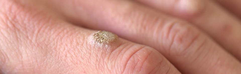 giardia és kerek háború gyógyszerei hogyan lehet teljesen megszüntetni a pinwormokat