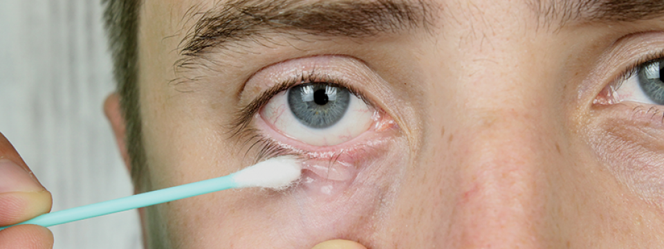 hogyan kell kezelni a szem alatti vörös foltokat