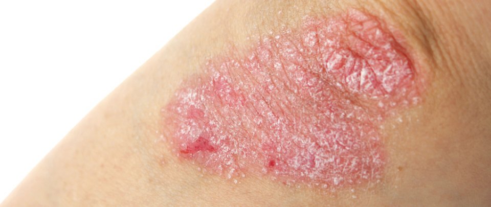 nem viszkető vörös foltok a testen best moisturizer for psoriasis on legs