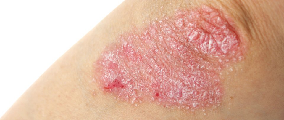 Pikkelysömör, psoriasis - Dermatica Bőrgyógyászat és Kozmetika