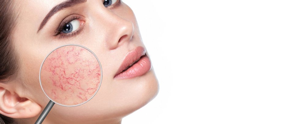 Rosaceás látás, A rosacea előfordulása és okai